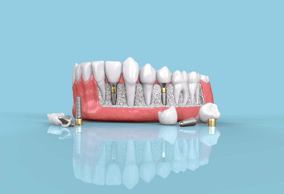 Dental Implants Fulshear, TX